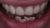 (13.) Case 1: Full-smile view of the definitive all-ceramic restoration on the maxillary right central incisor.