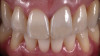 (16.) Case 2: Retracted full-smile view of the definitive all-ceramic restoration on the maxillary left central incisor.