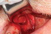 (2.) Elevation of Schneiderian membrane, demonstrating potential space prior to bone graft placement.