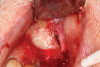 (3.) Placement of bone graft material into the lateral window.