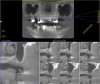 (4.) Preoperative cone-beam computed tomography (CBCT) image of the tooth No. 14 site prior to lateral sinus augmentation.
