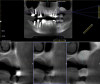 (5.) Postoperative CBCT image of the tooth No. 14 site taken 6 months after lateral sinus augmentation.