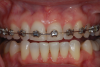 (13.) Retracted view of a patient who had been using tray application of 10% carbamide peroxide for over a year to clean the braces as well as bleach the teeth.