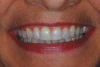 (14.) Smile photograph of the patient in Figure 13 immediately after removal of the arch wires and brackets, showing no white spot lesions or any yellow spots where the the bonded brackets were previously located.