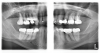 (2.) Patient required an extensive treatment plan, including multiple crowns and fillings in each quadrant.