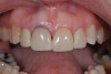 Fig 3. Tooth No. 8 had previous endodontics, a PFM crown, and various areas of interproximal decay.