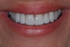 Fig 16. Improved esthetic result