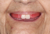 (2.) Maxillary wax rim in a patient’s mouth with denture teeth Nos. 8 and 9 set into place.