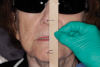 (5.) Full face photograph of patient with sunglasses on and tongue blade measuring the vertical dimension of occlusion and the vertical dimension at rest.