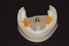 (8.) Gothic arch tracer gold pin held to white mandibular baseplate with orange sticky wax.