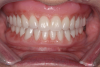 (12.) Retracted view of final complete dentures fabricated using this approach.