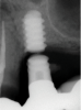 (8.) Mid-body fracture of a CP-Ti grade 4 implant related to overload and a longer fulcrum on the implant following bone loss.
