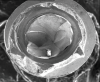 (9.) Deformation of the external hex connection and subsequent fracture of the coronal aspect of a CP-Ti grade 4 implant leading to fracture of the abutment screw at the interface.