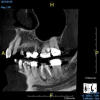 (2.) Two-dimensional periapical radiograph of tooth No. 19 compared with a CBCT scan slice (0.1 mm) of the same tooth, which reveals a well-defined lesion that a patient can more easily understand.