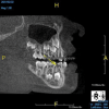 (3.) A pediatric rapid CBCT scan is only associated with about 25 µSv of radiation exposure, but here it permits the clinician to see the caries extending into the pulp of tooth S. Note how the developing teeth and all of the primary teeth in this mixed dentition can be visualized.