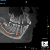 (10.) Tooth No. 31 in this 14-year-old patient does not exhibit caries. It is a “ghost tooth.” The lack of a periapical pathosis, the location of the tooth relative to the inferior alveolar nerve, and the development of tooth No. 32 are all visible in the CBCT image. These factors will aid the clinicians in developing a treatment plan to deal with this unusual internal resorption case.