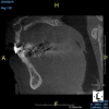 (12.) A pathosis apical to the maxillary central incisors was initially not diagnosed after evaluating the periapical film; however, the CBCT image revealed its presence. Only using the CBCT image could it be determined that the lesion was not odontogenic in origin and that it did not involve the nasopalatine foramen. This diagnosis was supported by a referral to an oral and maxillofacial radiologist.