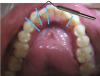 Fig 1. The Ataii 2,4,6 rule is used for quick chairside evaluation
of case complexity. A periodontal probe is used to measure the
crowding, spacing, and overlapping. A simple malocclusion is
defined as: 2 mm or less of correction needed for the midline,
intrusion vs extrusion, and crossbite; 4 mm or less of correction
needed for the open bite and overjet; and 6 mm or less of crowding
or spacing.