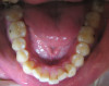 Fig 3. Candidates for hybrid teledentistry include patients with minor (Fig 2), moderate (Fig 3), and advanced crowding (Fig 4).