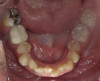 Fig 4. Candidates for hybrid teledentistry include patients with minor (Fig 2), moderate (Fig 3), and advanced crowding (Fig 4).