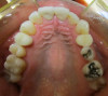 Fig 8. Clear aligner treatment was recommended to this patient, who presented with a missing lower molar combined with
posterior and anterior malocclusion.