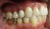 Fig 10. Clear aligner treatment was recommended to this patient, who presented with a missing lower molar combined with
posterior and anterior malocclusion.