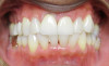Fig 11. Clear aligner treatment was recommended to this patient, who presented with a missing lower molar combined with
posterior and anterior malocclusion.