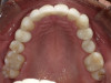Fig 16. After completion of treatment, improved anterior esthetics and replacement of upper restorations were achieved.