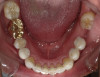 Fig 137. After completion of treatment, improved anterior esthetics and replacement of upper restorations were achieved.