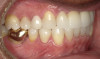 Fig 18. After completion of treatment, improved anterior esthetics and replacement of upper restorations were achieved.