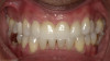 Fig 19. After completion of treatment, improved anterior esthetics and replacement of upper restorations were achieved.