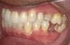 Fig 20. After completion of treatment, improved anterior esthetics and replacement of upper restorations were achieved.