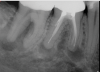 (1.) Preoperative radiograph of teeth Nos. 30 and 31 exhibiting previously treated, symptomatic apical periodontitis and pulp necrosis with a chronic apical abscess and an endodontic-periodontic lesion, respectively.