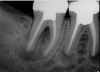 (2.) Postoperative radiograph after the performance of nonsurgical root canal re-treatment on tooth No. 30 and root canal therapy with hydraulic condensation and bioceramic sealer on both teeth followed by amalgam core buildups. (Case courtesy of David Tran, DMD, Advanced Graduate Program in Endodontics, Harvard School of Dental Medicine).