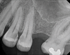 (3.) Preoperative radiograph of asymptomatic carious exposures on teeth Nos. 12 and 13.