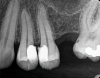 (4.) Postoperative radiograph of teeth Nos. 12 and 13 following treatment with direct pulp caps using a bioceramic dentin substitute material.