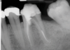 (6.) Postoperative radiograph showing immediate perforation repair using MTA followed by complete obturation.