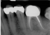 (7.) One-year follow-up periapical and bitewing radiographs demonstrating the absence of apical pathosis or furcal pathosis at the site of 
the perforation.