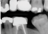 (8.) One-year follow-up periapical and bitewing radiographs demonstrating the absence of apical pathosis or furcal pathosis at the site of 
the perforation.