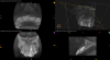 (12.) Postoperative radiograph after apical surgery was performed using MTA as an apical retrofilling material.