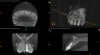 (13.) Normal healing was noted clinically and radiographically at the 6-month follow-up appointment.