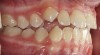 (16.) Tongues with poor tone and posture may move the teeth over time and open the bite (Case courtesy of James Awbrey, DMD).