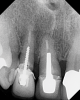 (3.) Radiograph of a loose screw-style metal post.