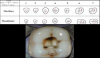 Fig 3. Top: Diagram of canal locations and shapes of access openings in maxillary and mandibular molars. Bottom: The photograph displays a mandibular first molar with a distal canal and two mesial canals.