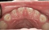 (20.) Maxillary anterior tooth wear. Adenotonsillectomy (T&A) performed and postoperative apnea-hypopnea index (AHI) was 6.1. Continued therapy recommended for resolution.