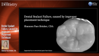 Dental Sealant Failure, Caused by Improper Placement Technique Webinar Thumbnail