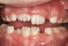 (21.) Six-year-old male presents nocturnal bruxism, habitual snoring, and behavioral issues. PSG reports an AHI of 9.6/hr and respiratory effort–related arousal (RERA) of 14.2/hr (Case provided by Kathy French, DDS).