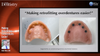 Making Retrofitting Overdentures Easier! Webinar Thumbnail