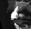 (2.) Preoperative CBCT analysis demonstrating a fistula from the site of the radiolucency to the oral environment.