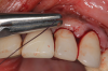 (9.) A sling suture technique was used to reposition and secure the reflected tissue.